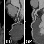 Cardiac Computed Tomography Angiography in the Evaluation of Coronary ...